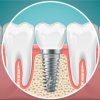 Benefits-of-Root-Canal-Therapy