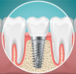 Benefits-of-Root-Canal-Therapy